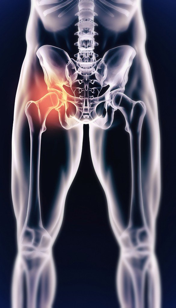 Kalça Kireçlenmesi