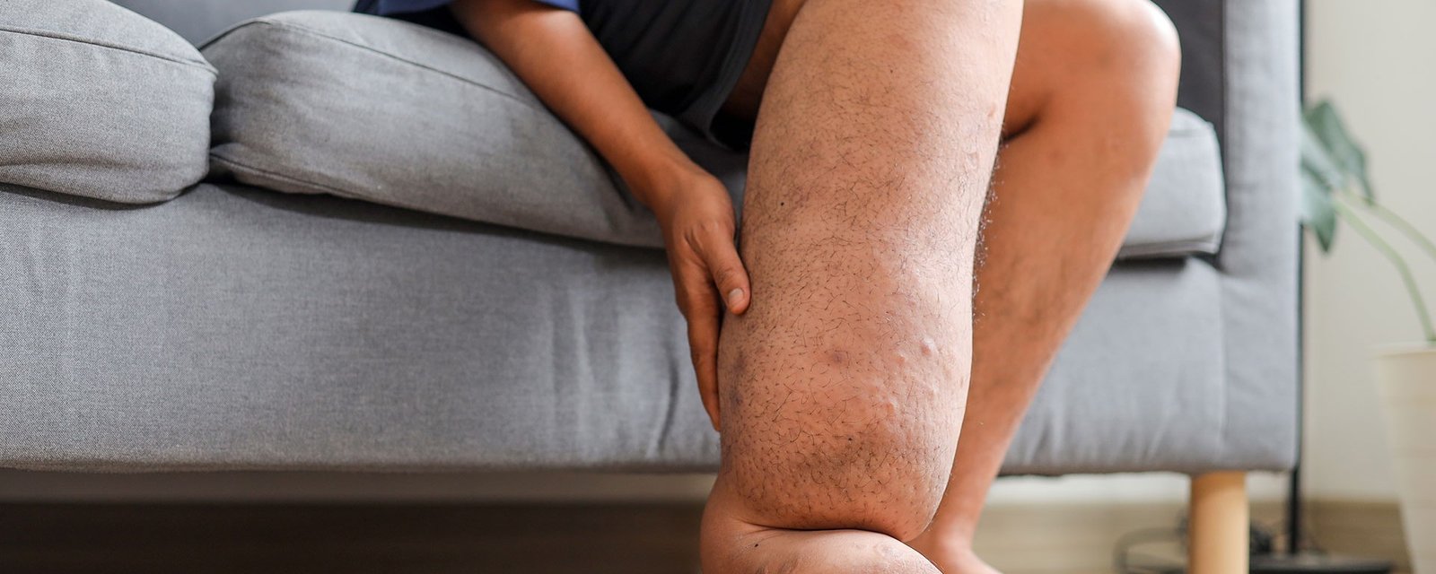 Lenfödem (Fil Hastalığı)