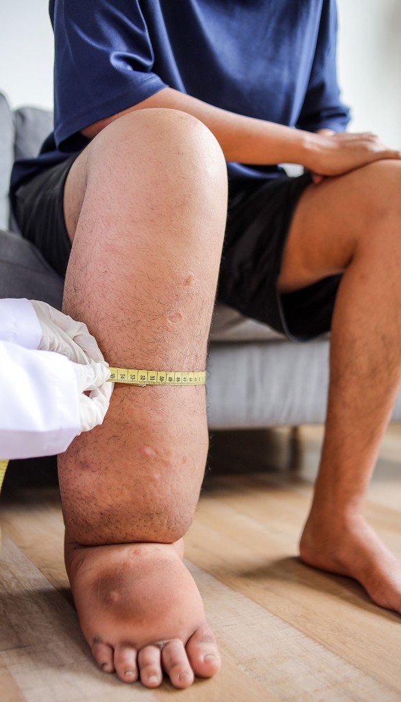 Lenfödem (Fil Hastalığı)